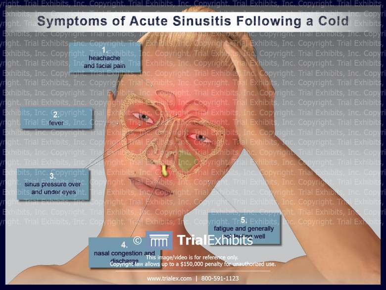 Symptoms of Acute Sinusitis Following a Cold