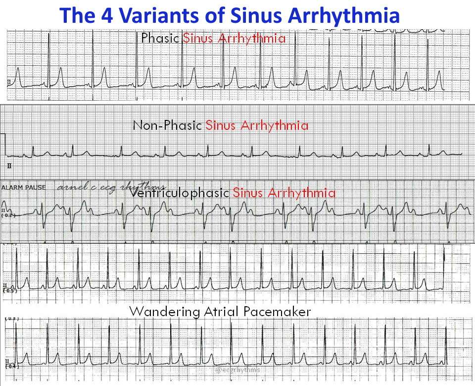 The 4 Variants of Sinus Arrhythmia Phasic Sinus Arrhythmia: ...