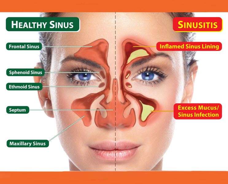 The Unconventional Guide to Healing Sinus Infections ...