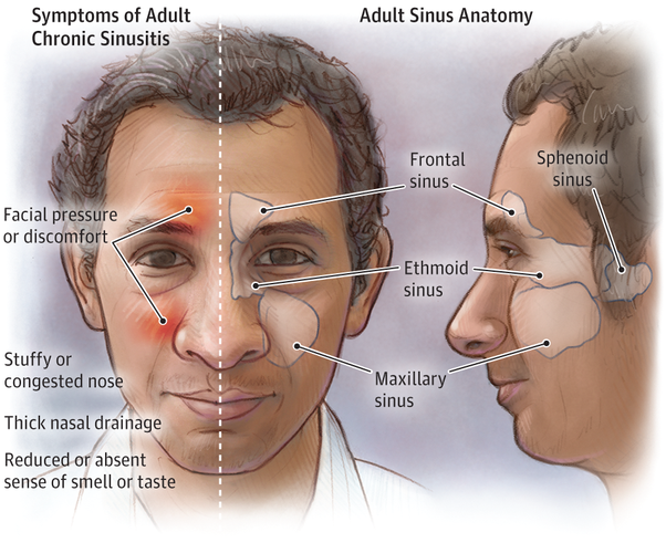What are the symptoms of sinusitis?