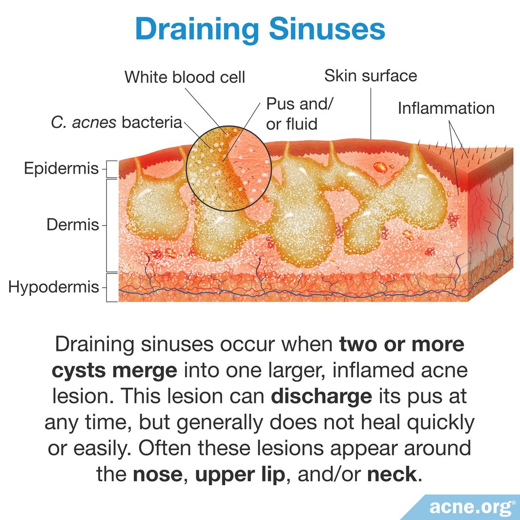What Is a Draining Sinus?