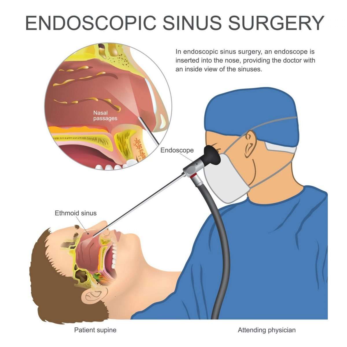 What is a Nasal Endoscopy Procedure? (Indications, Side Effect &  Uses)