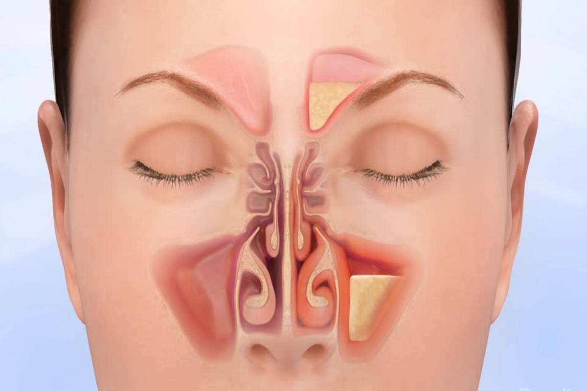 What is Sinus Infection? â Definition, Symptoms, Treatment