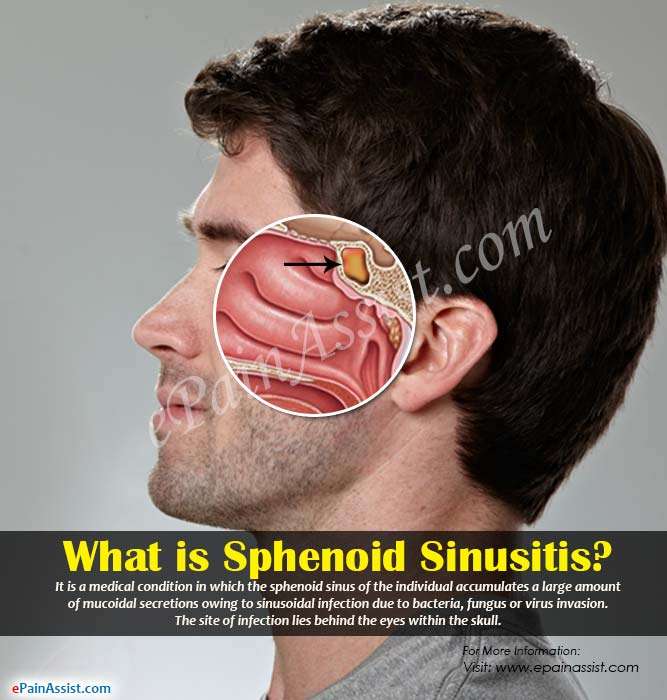 What is Sphenoid Sinusitis