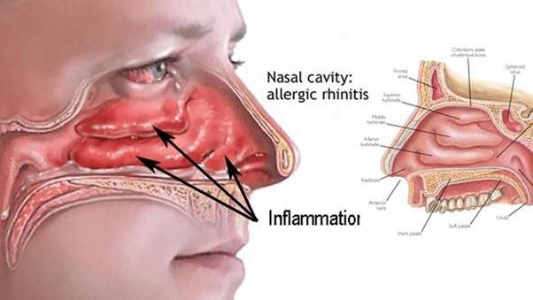 What is the best way to sleep with a cold/nasal congestion ...