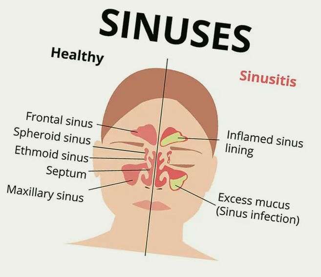 When Do You Really Need Antibiotics For That Sinus Infection?